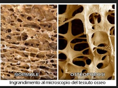 Curare l’Osteoporosi con la Medicina Ortomolecolare